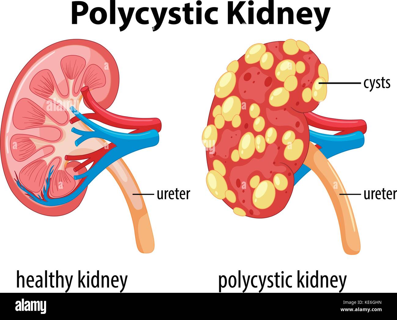Diagrama que muestra la ilustración de la poliquistosis renal Imagen