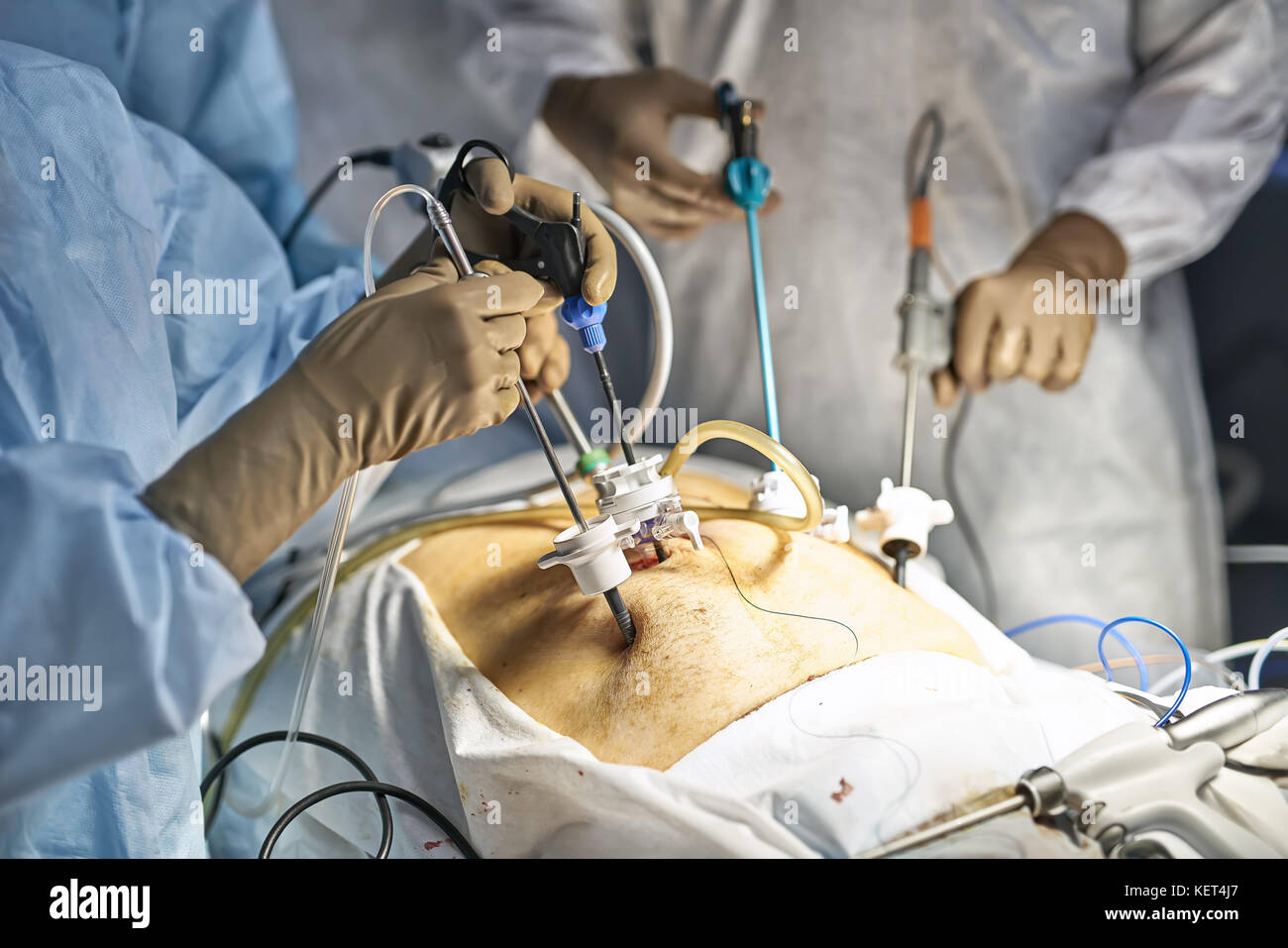 Equipo de cirujanos están utilizando laparoscopia cámaras dentro del  abdomen del paciente durante la operación. closeup. horizontal Fotografía  de stock - Alamy