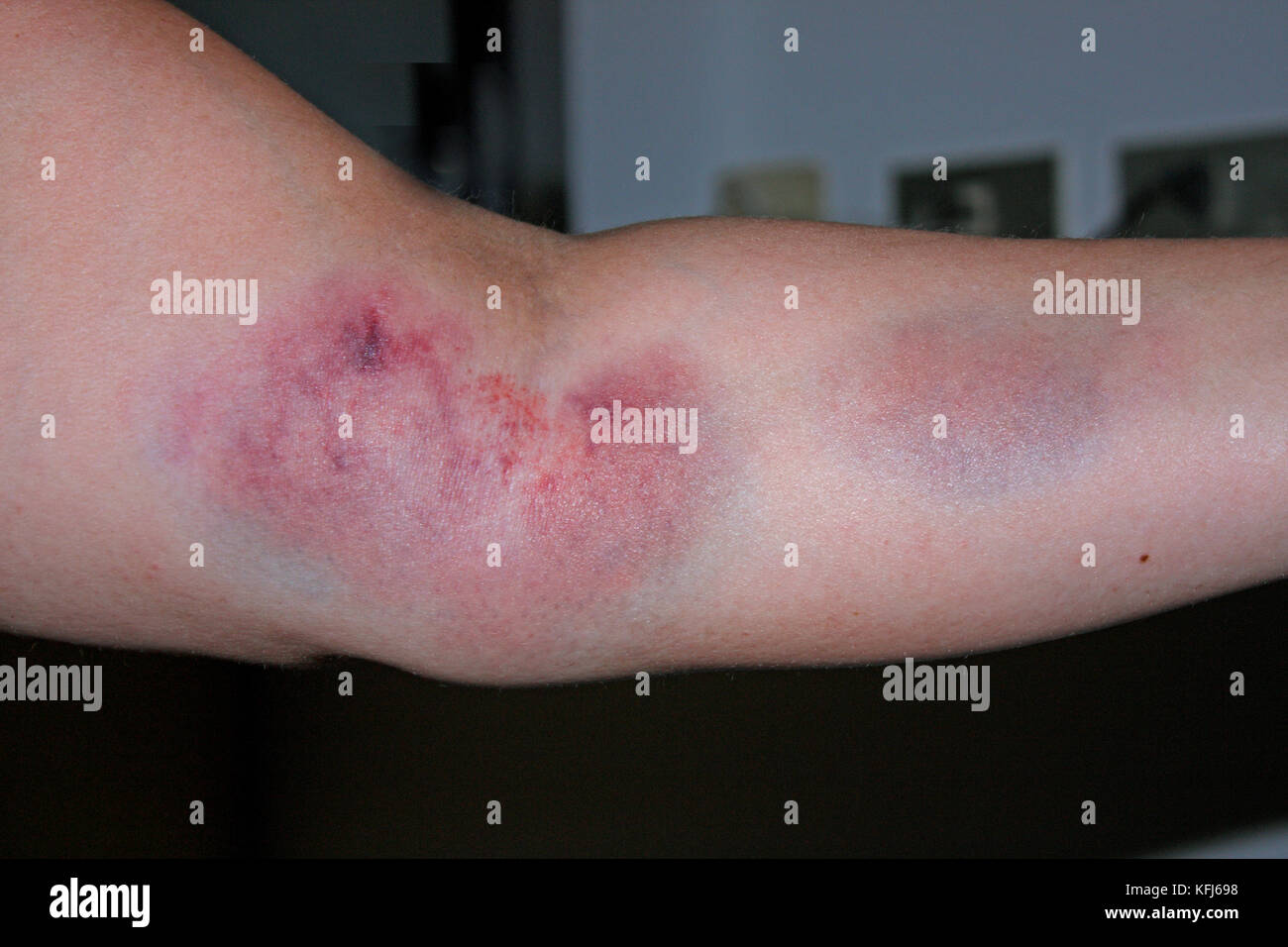 Bluterguss, Hämatom nach dem Bogenschießen oder einem Unfall Fotografía de stock Alamy