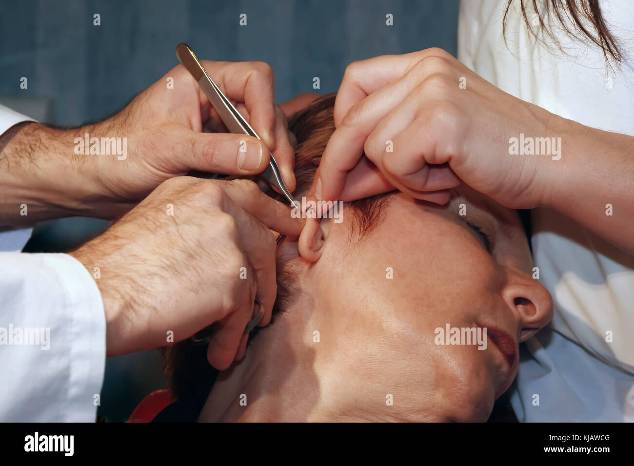 Las puntadas se eliminará de la oreja del paciente. Foto de stock