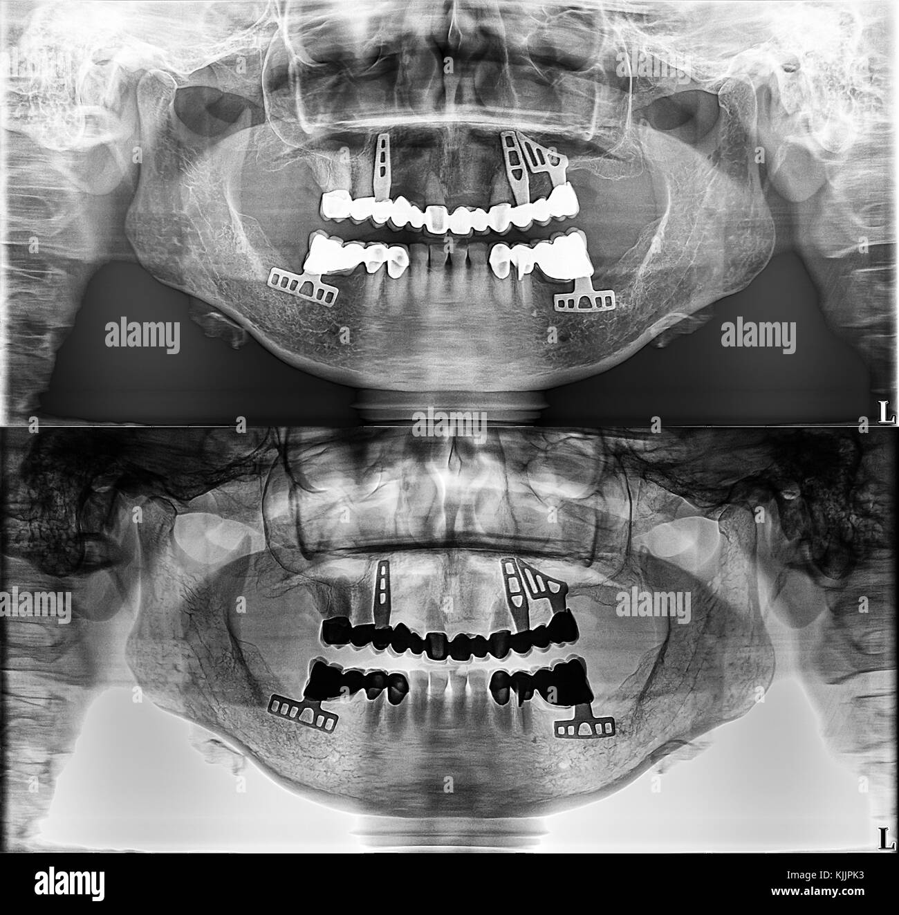 Panorámicas de rayos X dentales, dientes fijos, junta de amalgama