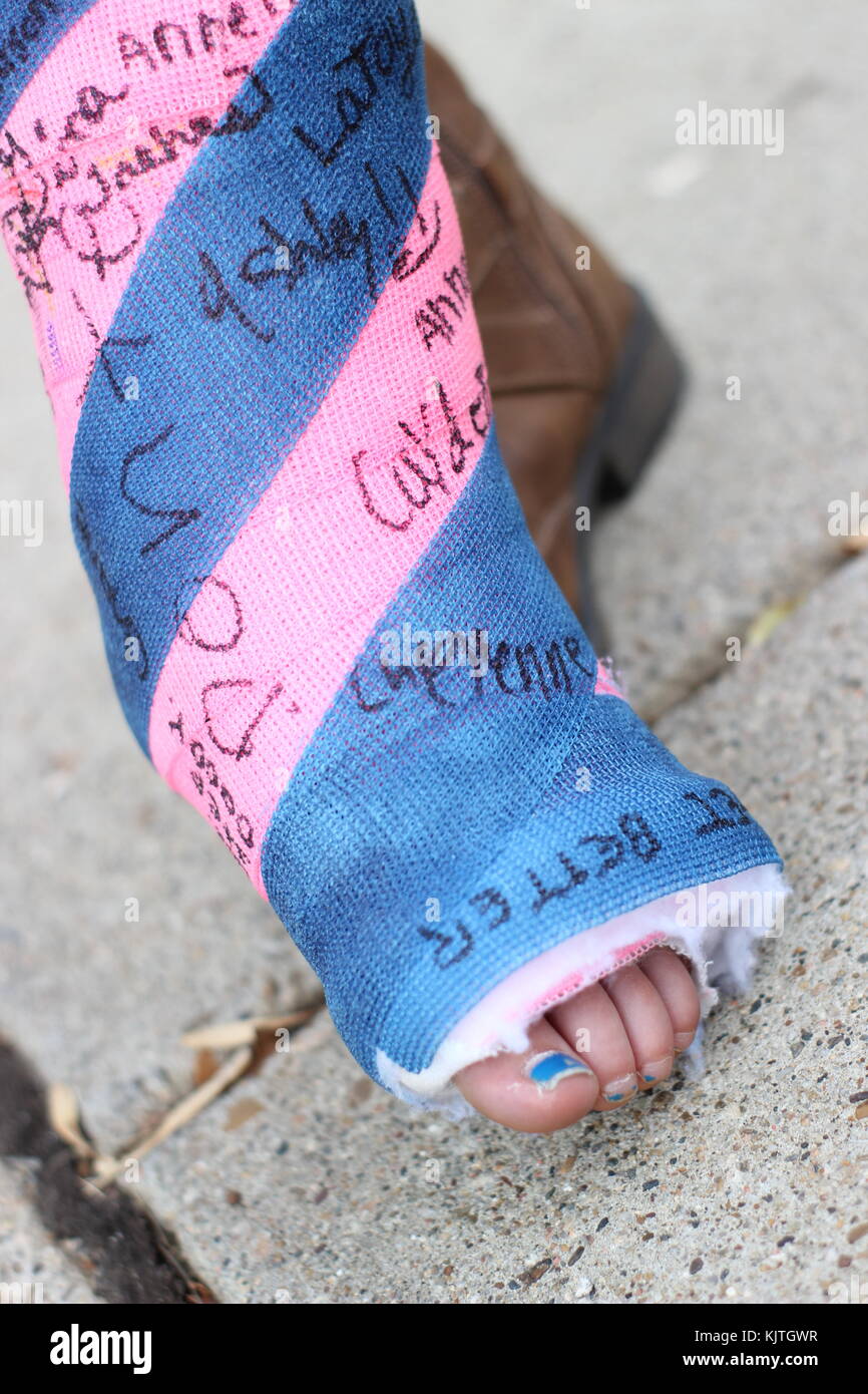 Cerca de un pequeño childs fundido en el pie y el tobillo con firmas, rosa y azul Foto de stock