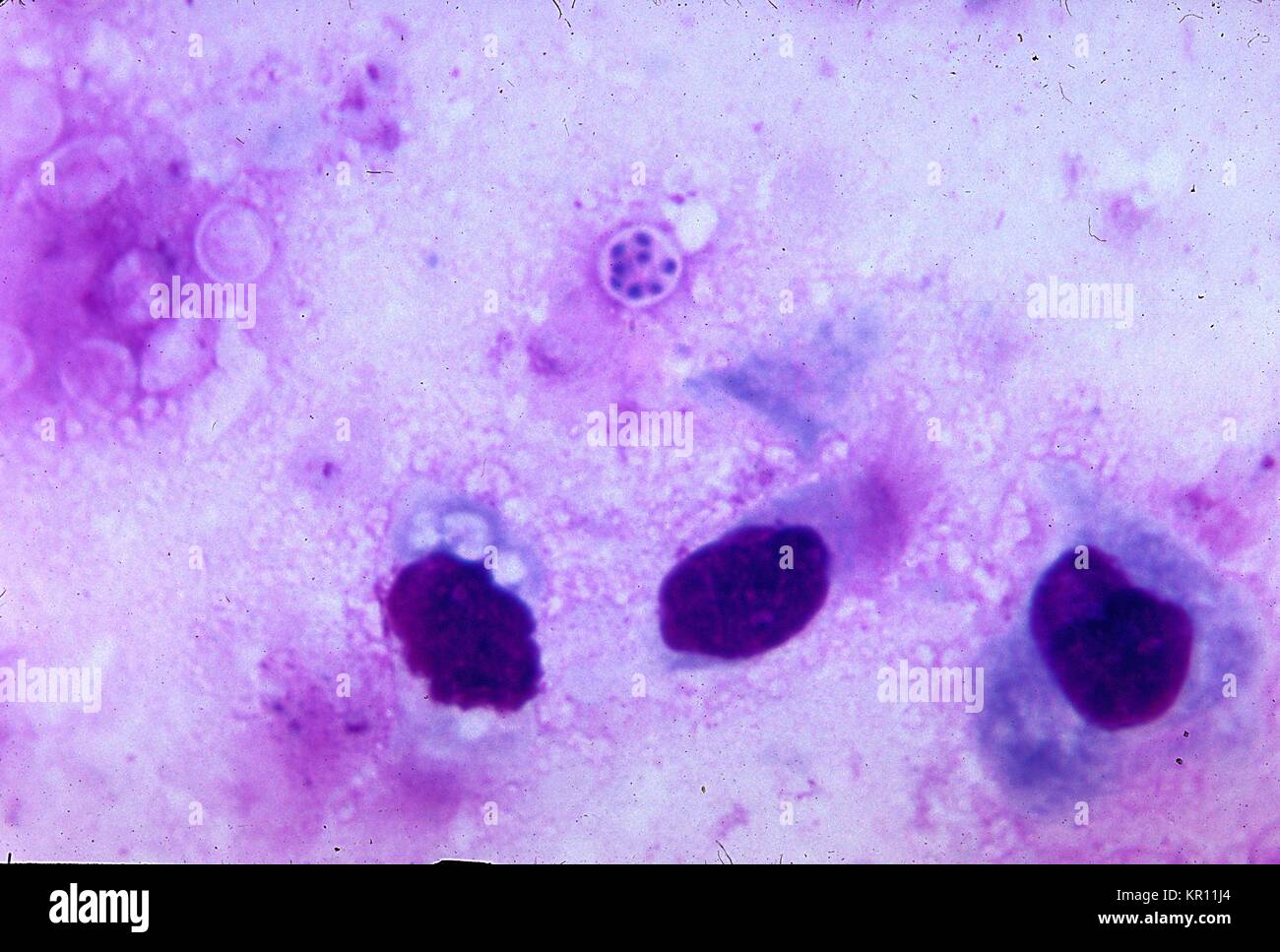 Pneumocystis Jiroveci Gram Stain