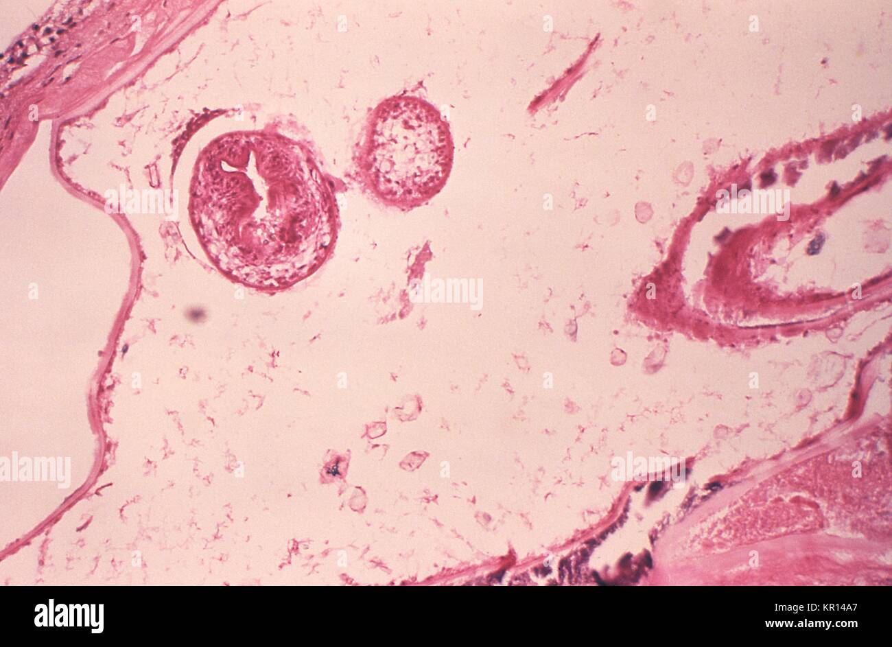 Esta micrografía es de una lesión de larvas en un vole experimentalmente infectados con el parásito Echinococcus multilocularis, 1978. La etapa larval de la microscópica tenia Echinococcus multilocularis es uno de los agentes causales de la Hidatidosis alveolar (AHD). La infección en humanos causa tumores parasitaria para formar principalmente en el hígado, pero también puede aparecer en otros órganos. Imagen cortesía de CDC/Dr. Peter Schantz. Foto de stock
