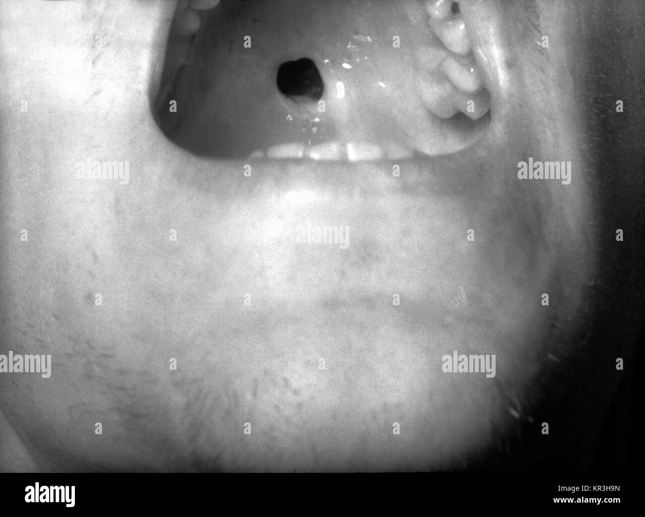 Esta fotografía muestra un paladar duro perforado en un paciente con sífilis congénita. Este paciente con sífilis congénita ha desarrollado una perforación del paladar duro debido a la destrucción gomosa, 1971. Estos tumores destructivos también pueden atacar la piel, los huesos largos, ojos, membranas mucosas, garganta, hígado o estómago. Imagen cortesía de CDC/Susan Lindsley. Foto de stock