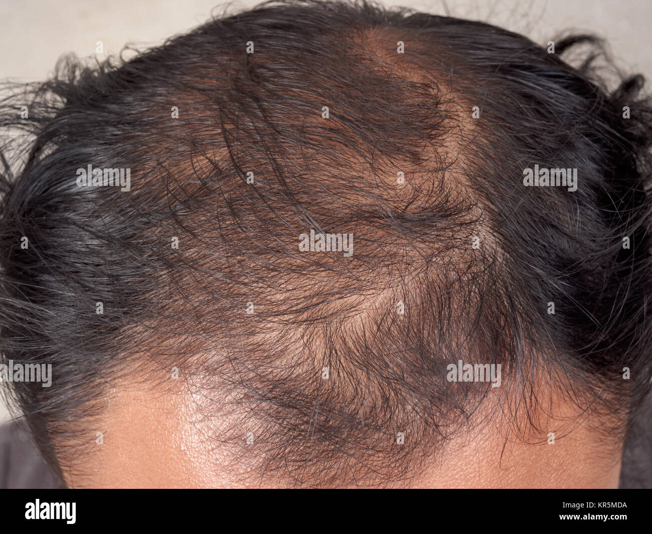 Primer plano de cabello en la cabeza calva o perder el hombre Fotografía de  stock - Alamy