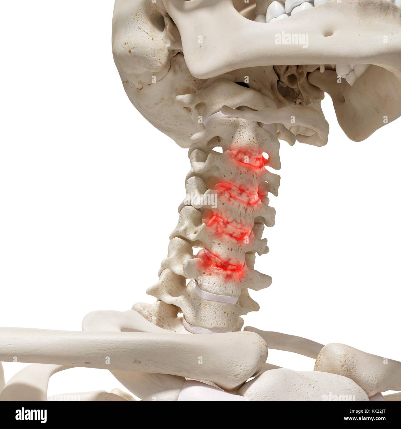 Artritis en la columna cervical, la ilustración Fotografía de stock - Alamy
