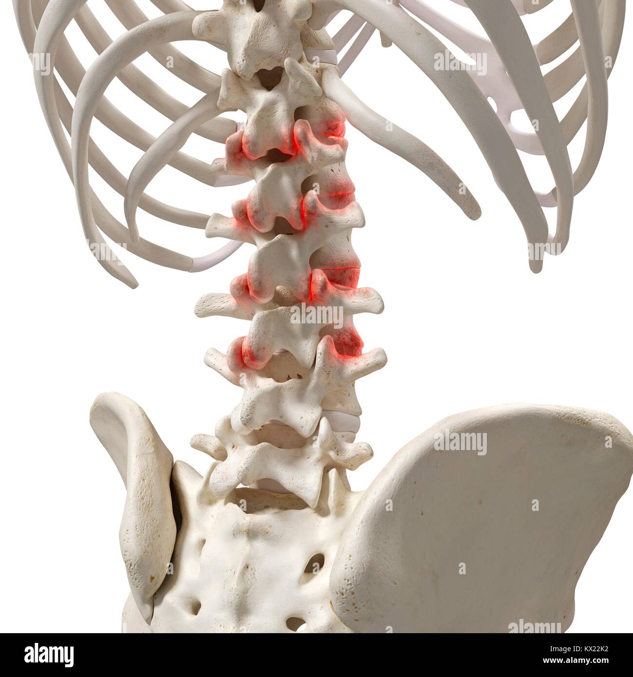 Artritis en la columna vertebral, la ilustración Fotografía de stock