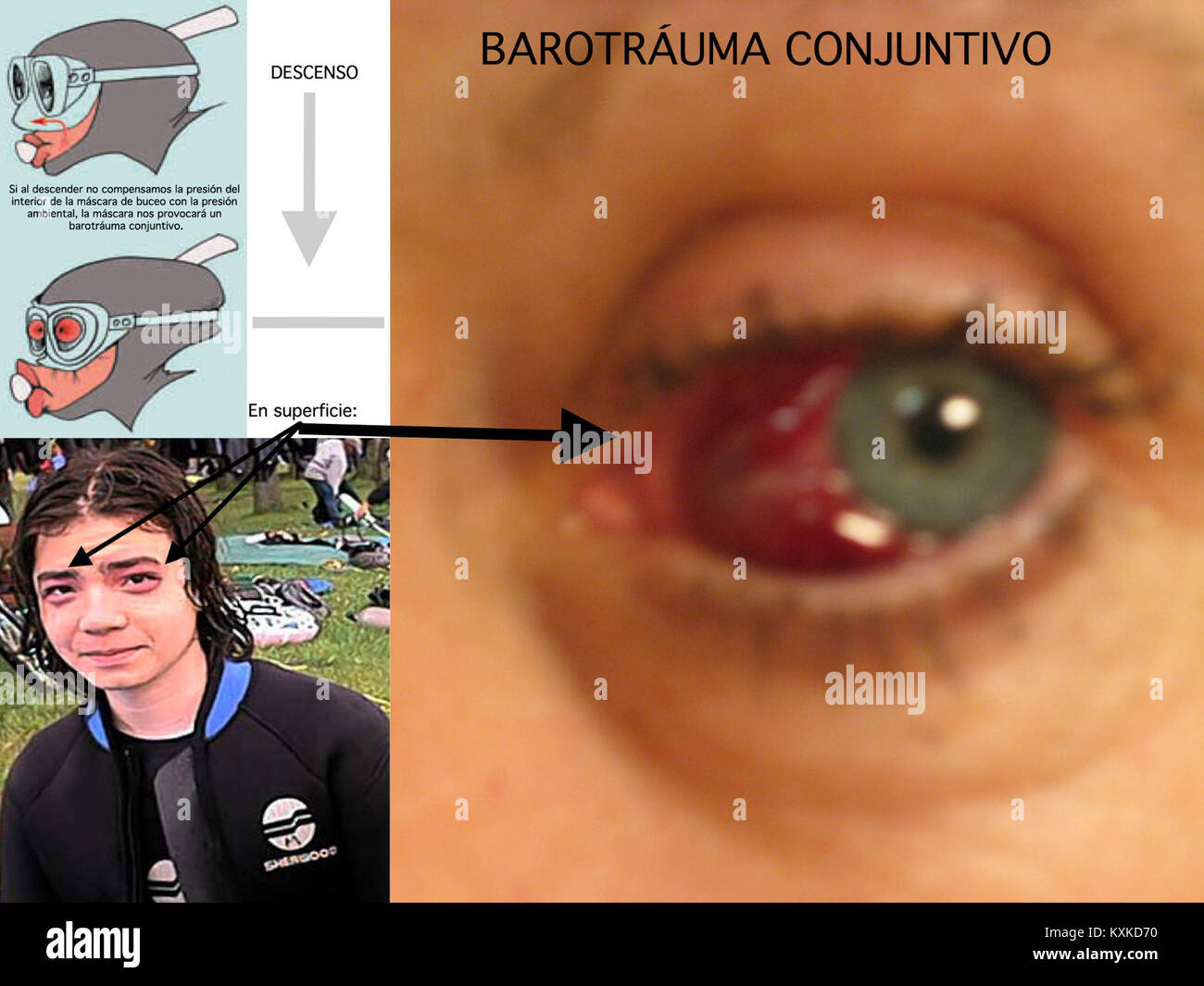 Гарнитура с инжектором barotrauma