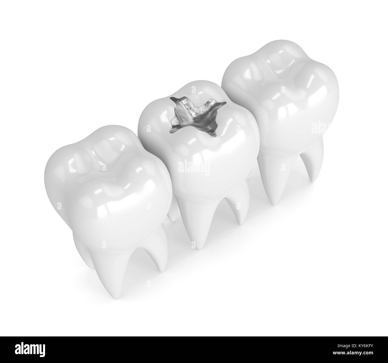 3D Render de los dientes con amalgama dental llenado sobre fondo blanco  Fotografía de stock - Alamy