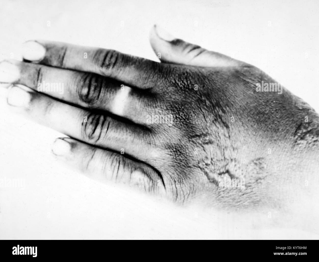 Una lesión del gas mostaza, ARP formación diapositiva, WW2 Fotografía