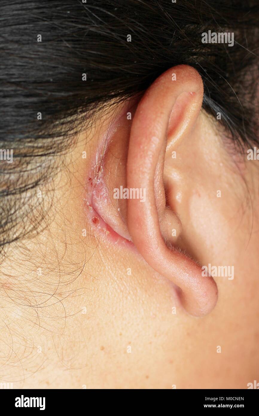 Herida detrás de la oreja Fotografía de stock - Alamy
