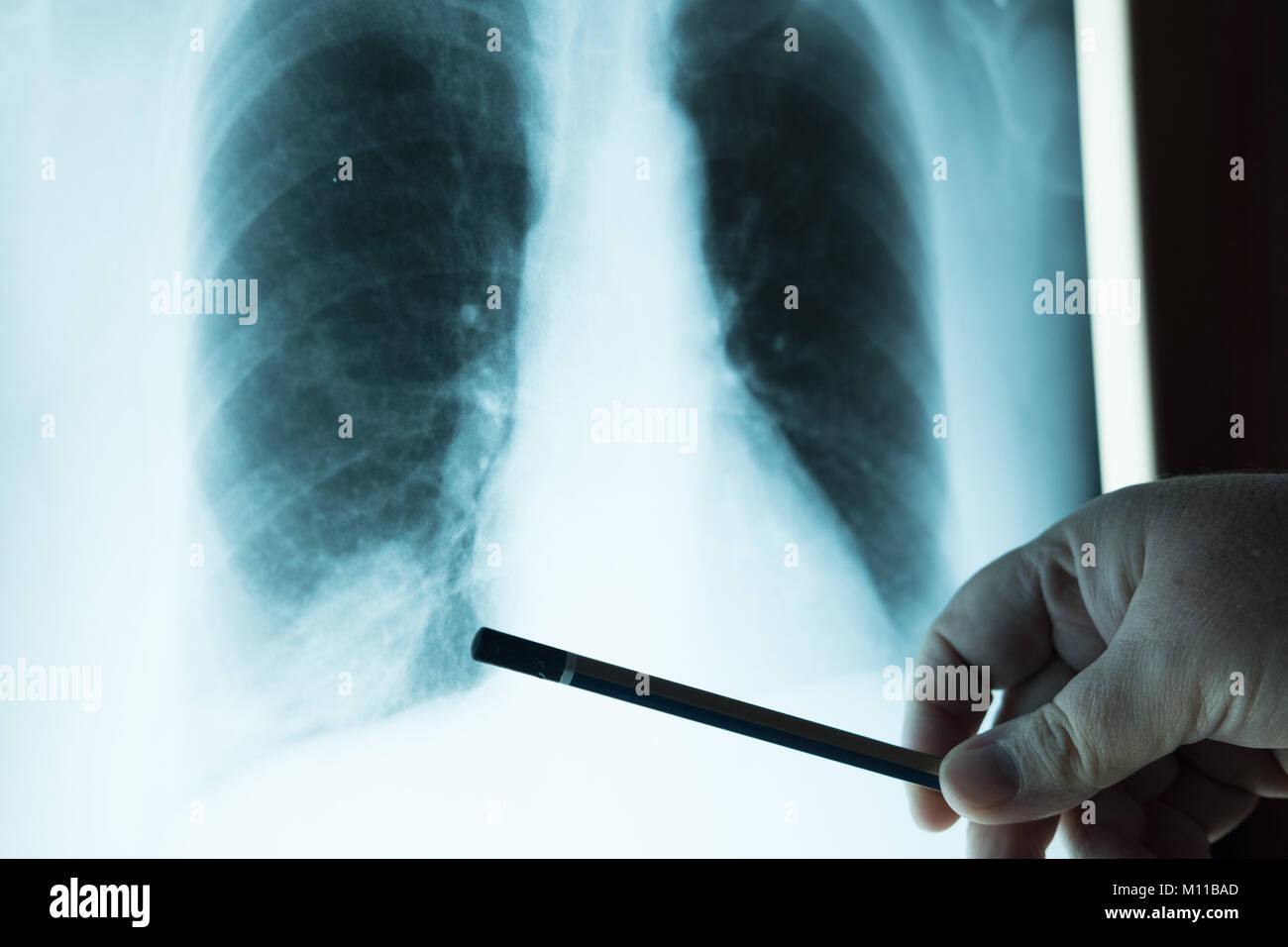 Control médico de la película de rayos X de tórax. Médico examina una