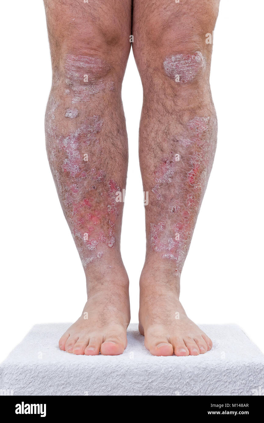 La psoriasis es una enfermedad inflamatoria crónica de la piel.Detalles de  las piernas Fotografía de stock - Alamy