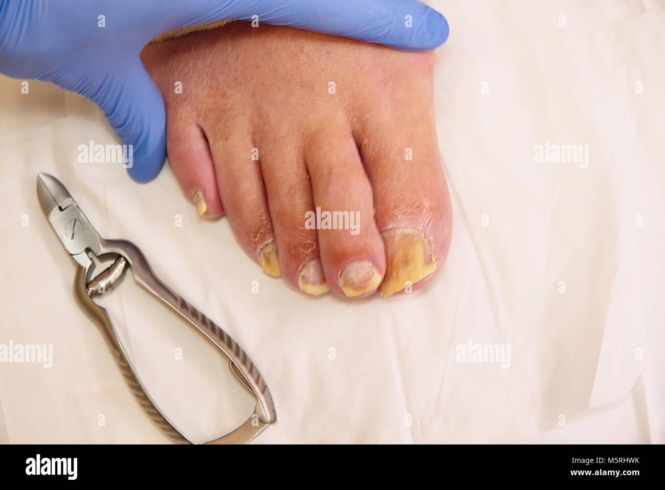 Hongos en las uñas de los dedos de los pies. Dedos del pie torcido en