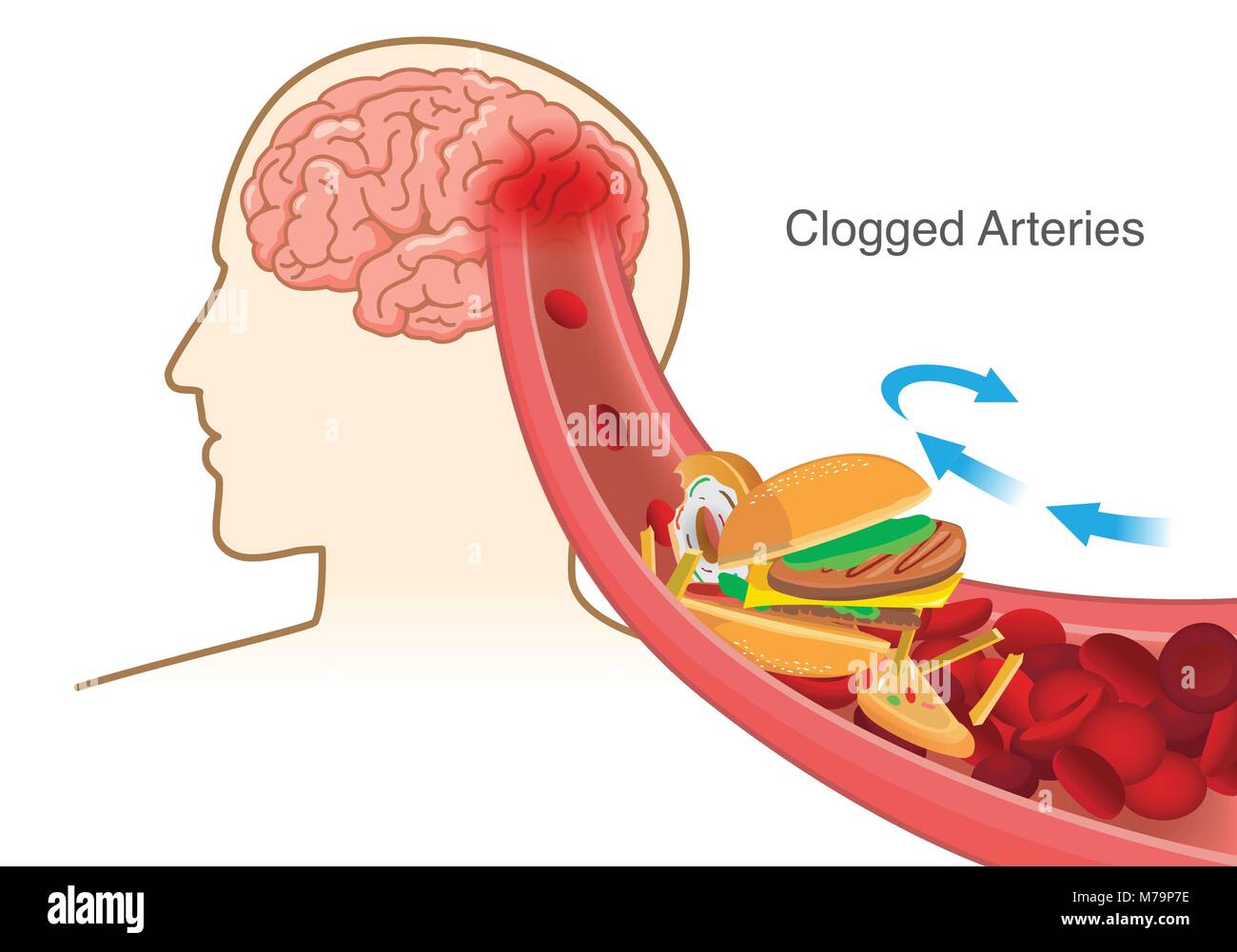 Y pizza, hamburguesas y papas fritas causa glóbulos rojos bloque obstruidas en arteria antes en el cerebro. Ilustración del Vector