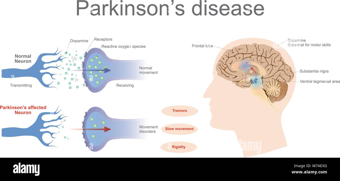 Los niveles de dopamina en una parte normal y una neurona afectada de Parkinson. Gráfico vectorial arte, ilustración. Ilustración del Vector