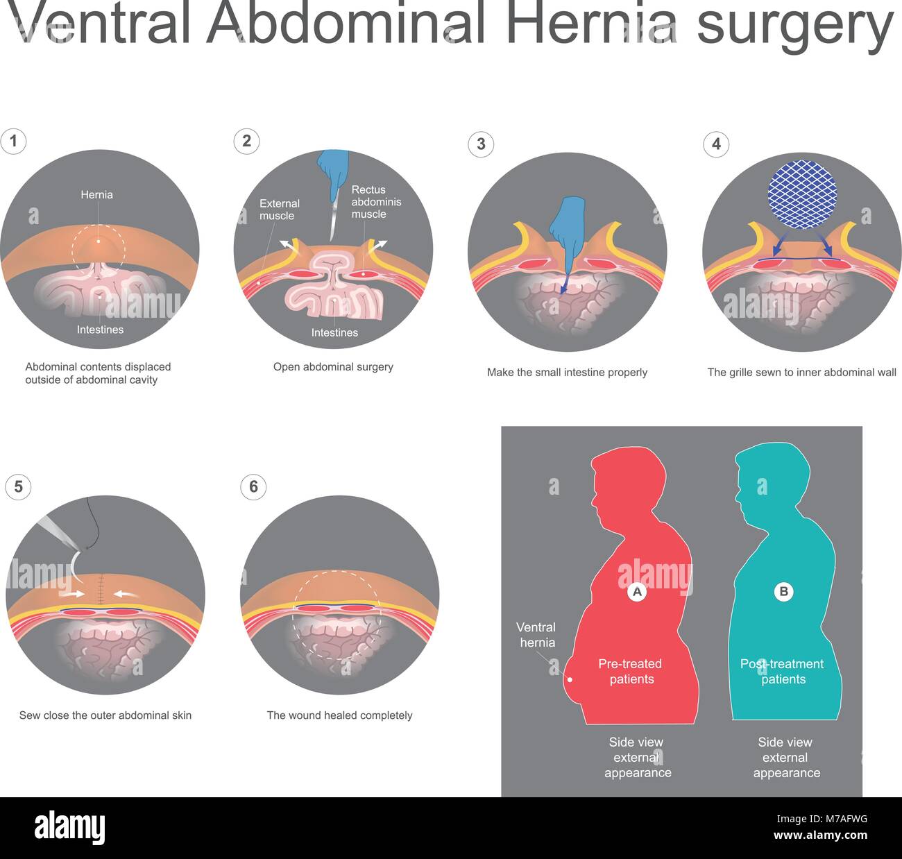 Hernia ventral es un abultamiento de los tejidos a través de una abertura de debilidad en sus músculos de la pared abdominal. Información gráfica vectorial. Ilustración del Vector