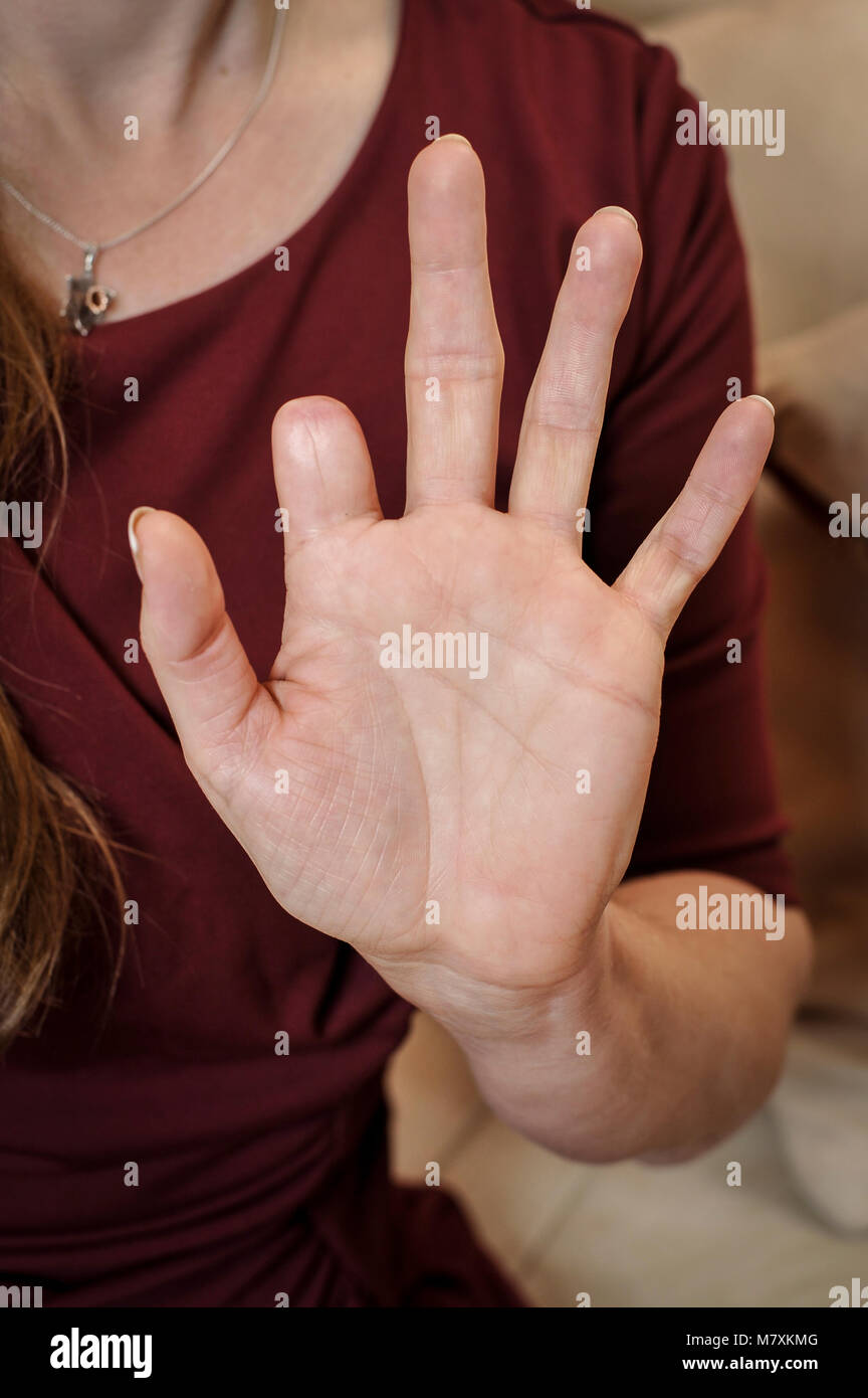 La amputación del dedo índice de la mano izquierda de una mujer. Foto de stock