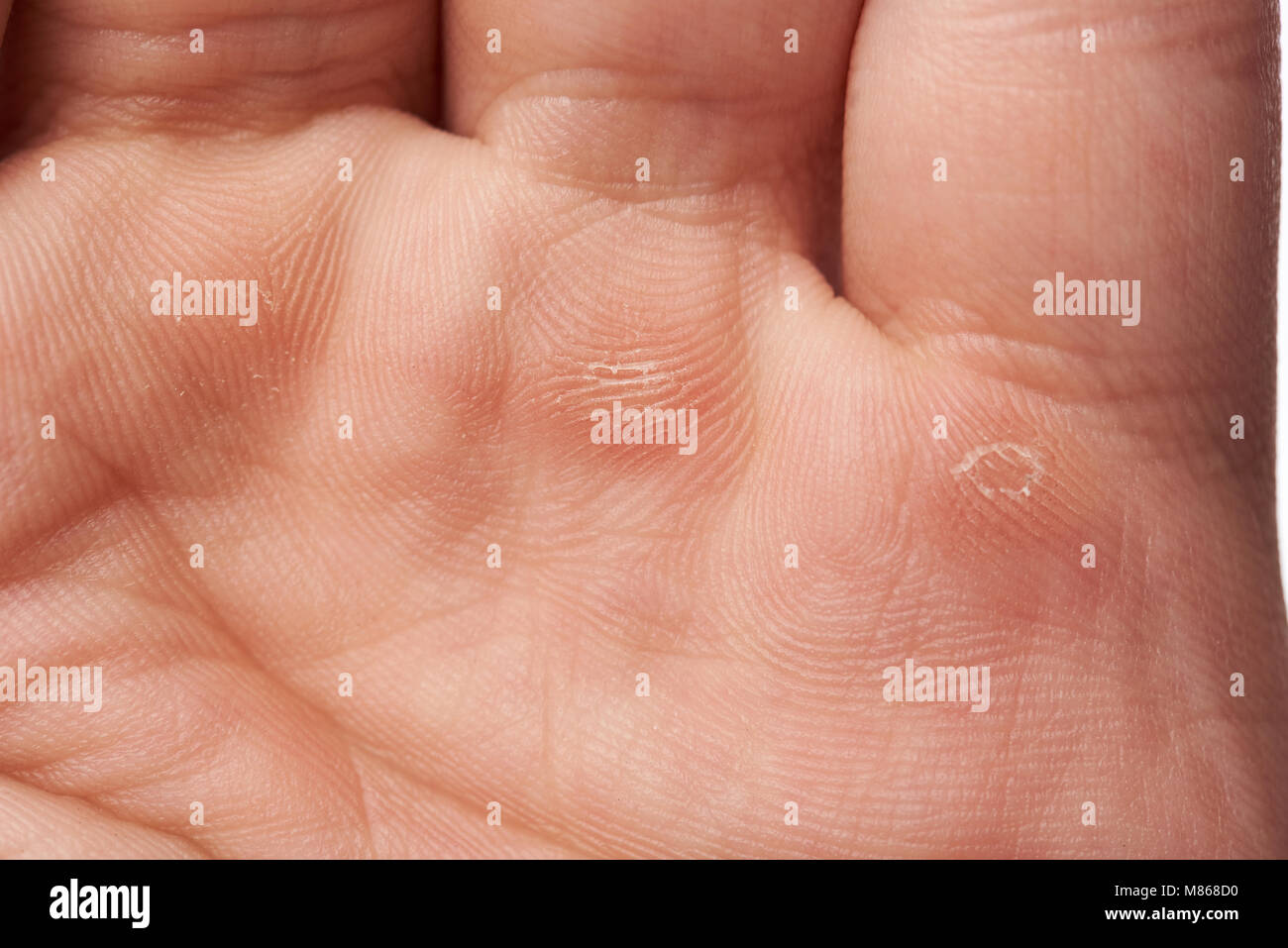 Ampolla en la palma de la mano fotografías e imágenes de alta resolución -  Alamy