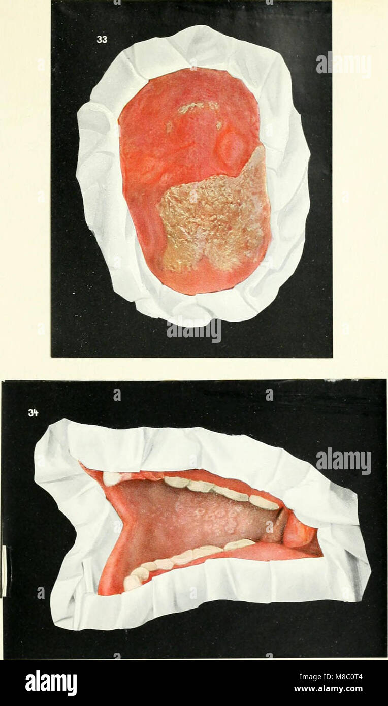 Enfermedades de la boca; para médicos, dentistas, médicos y estudiantes dentales (1912) (14769809721) Foto de stock