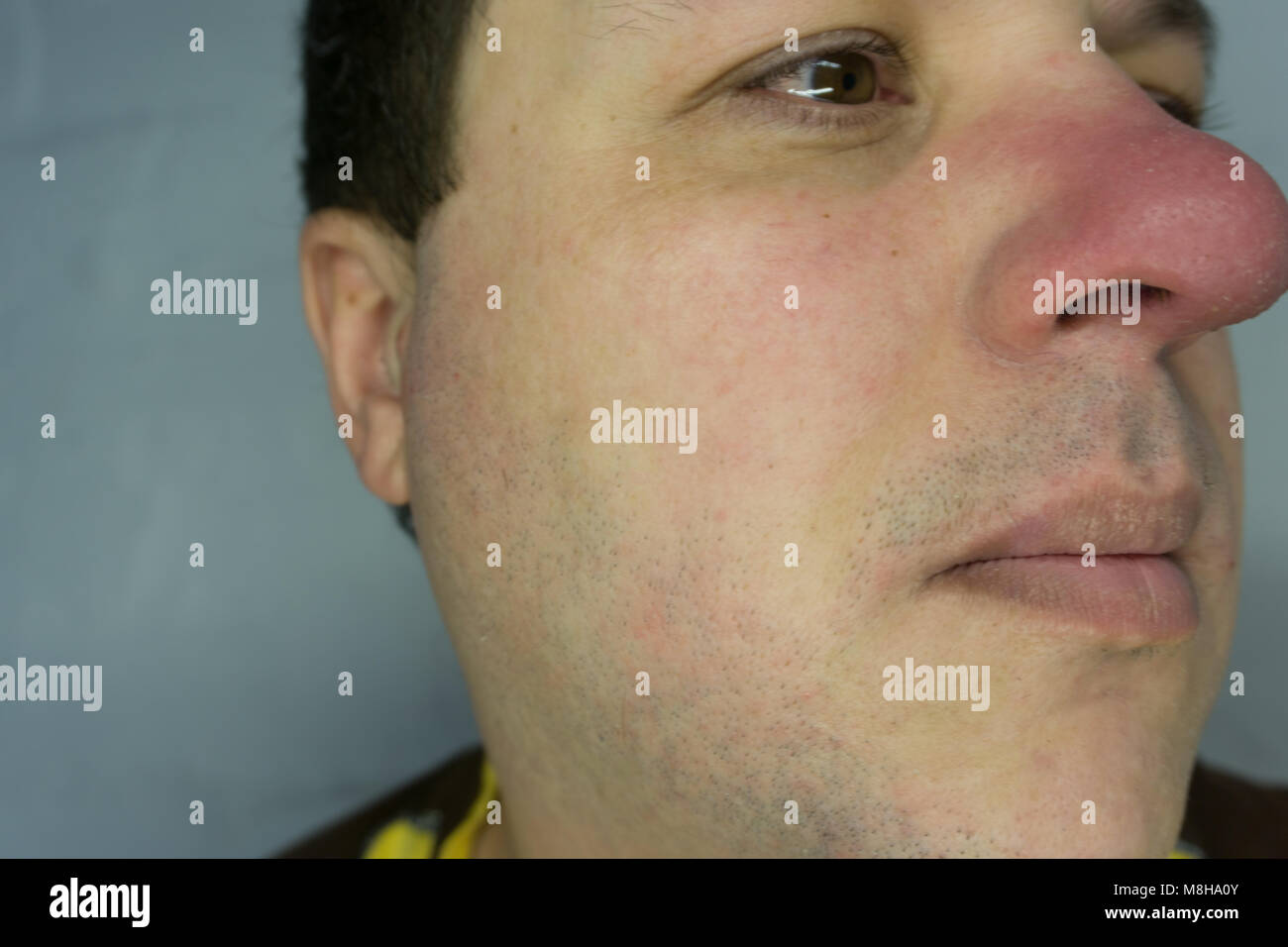 Nariz rota closeup. El hombre es el sangrado de la nariz Fotografía de