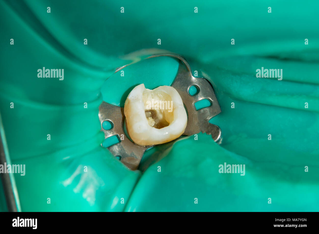 Closeup tratadas en un diente humano podrido obturación dental clinic