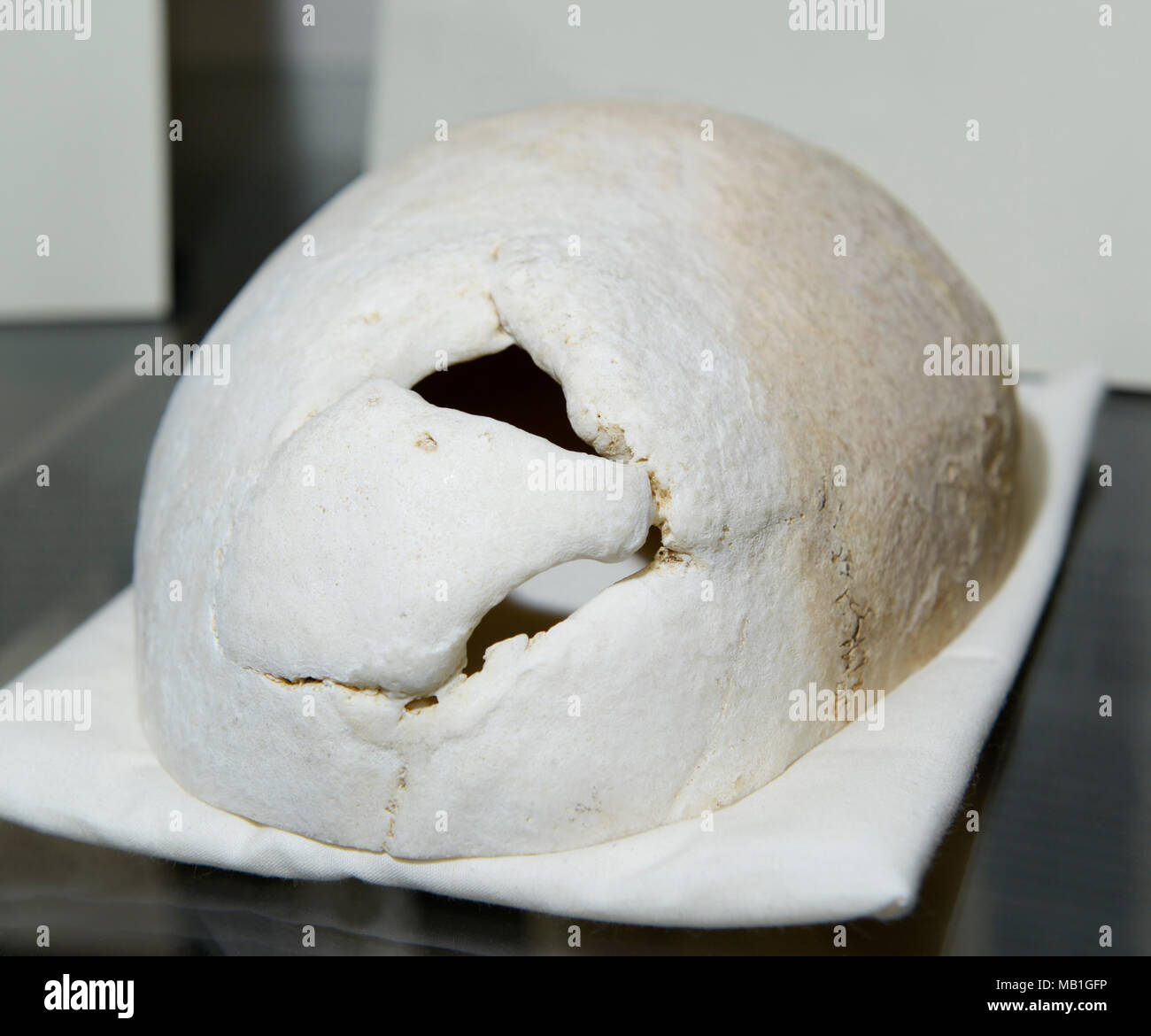 Phineas Gage cráneo, en exhibición en la Escuela de Medicina de Harvard. Agujero en el cráneo muestra dónde prensarlo hierro atravesó su lóbulo frontal en 1848. Foto de stock