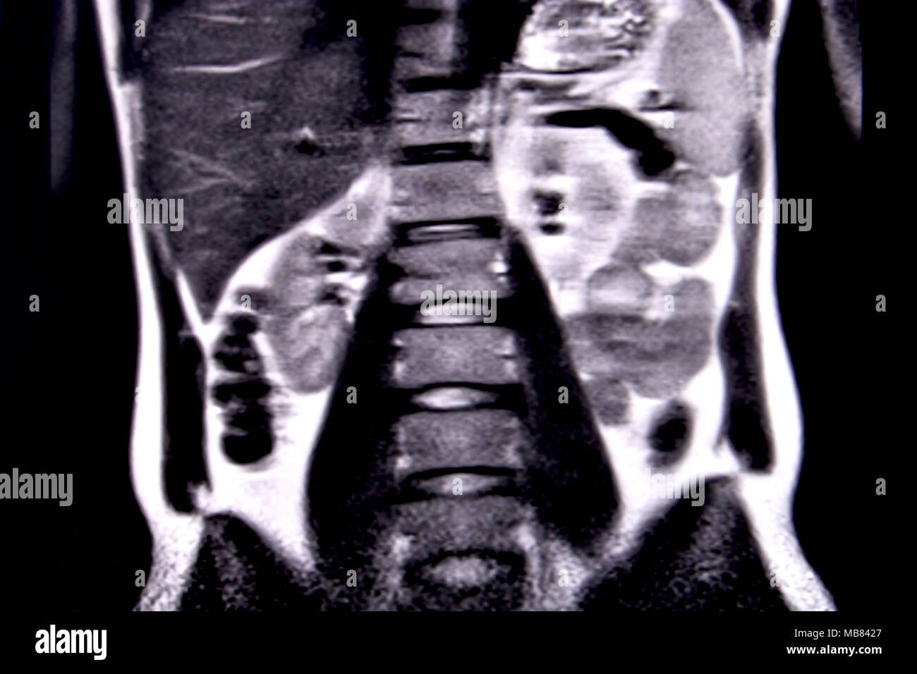 Viaje a través del abdomen y el tórax humano por medio de la resonancia magnética de 18 cortes coronales (ver). Imagen 8/18 Foto de stock