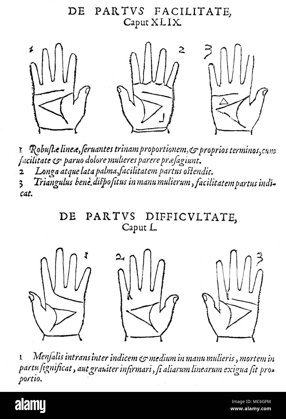 La quiromancia seis palmas y las correspondientes lecturas, relacionadas  con el parto, de Johannes Taisnier, Opus Mathematicus, 1562. Los tres  primeros tratan con signos fijos en la mano que garantizan una fácil