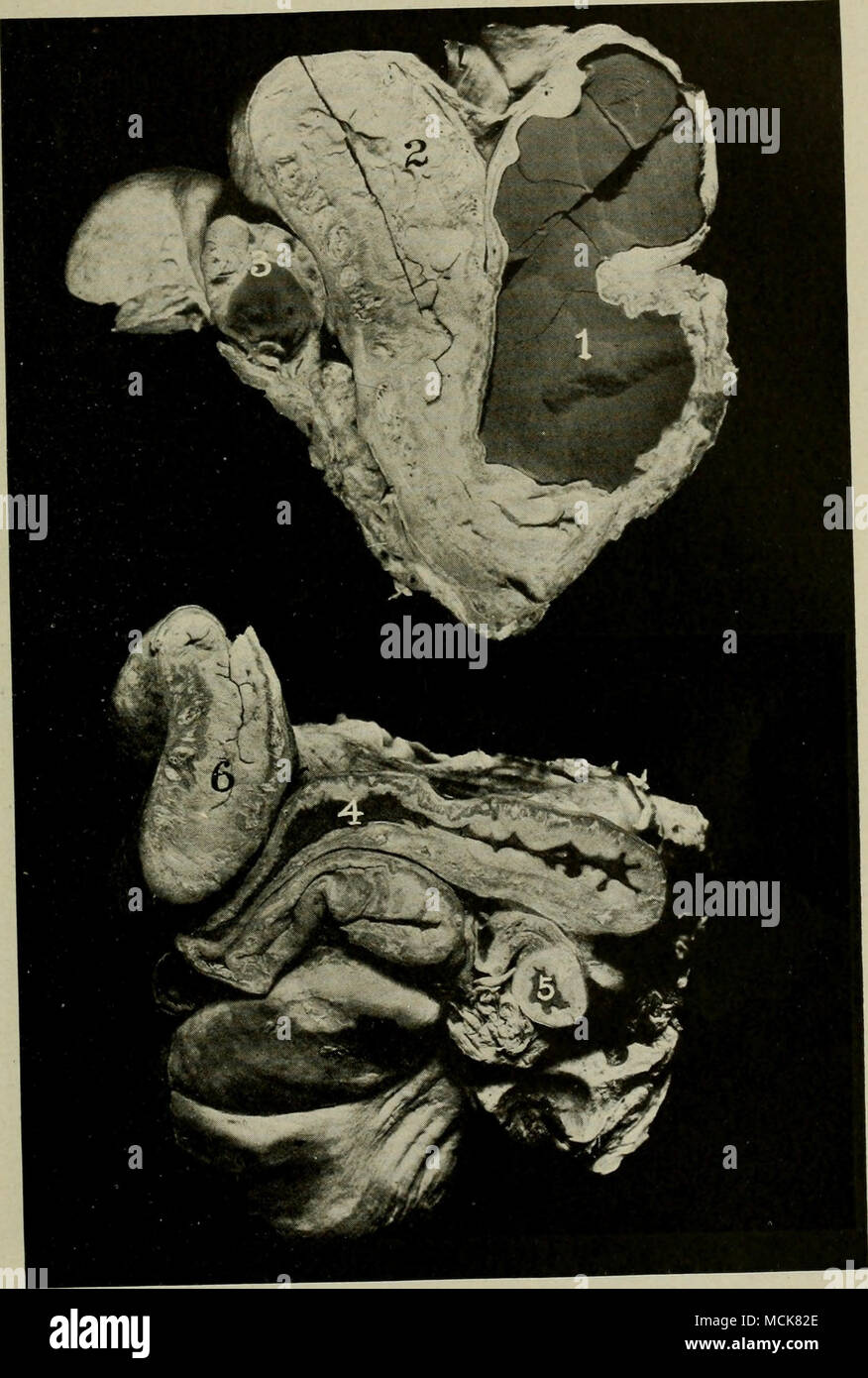 . 177-cerdo antiguo hematoma de Rig-ht cuerno uterino. Una vista desde arriba. /, Hematoma ; 2, Left cornu aparentemente sano ; 7 sección a través de ovario izquierdo mostrando cuerpo lúteo. b superficie ventral. 4. sección longitudinal a través de la bocina derecha ; 5, sección transversal a través de la bocina derecha, mostrando un hematoma ; 6, sección a través de la bocina izquierda normal. Foto de stock