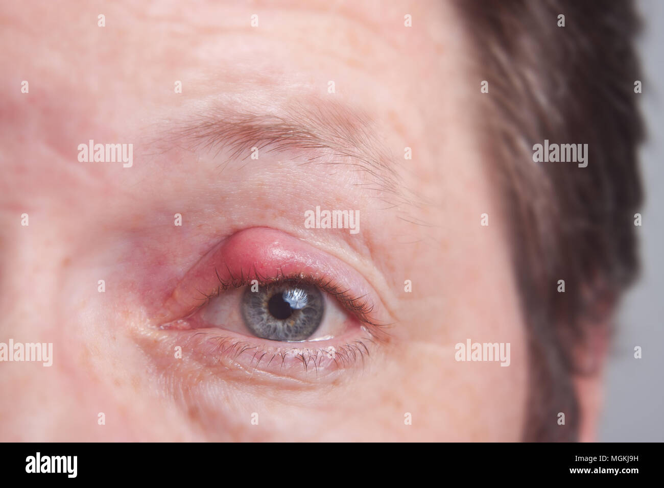 Dolorosamente sty ojo rojo, ojo purulento infectados Foto de stock