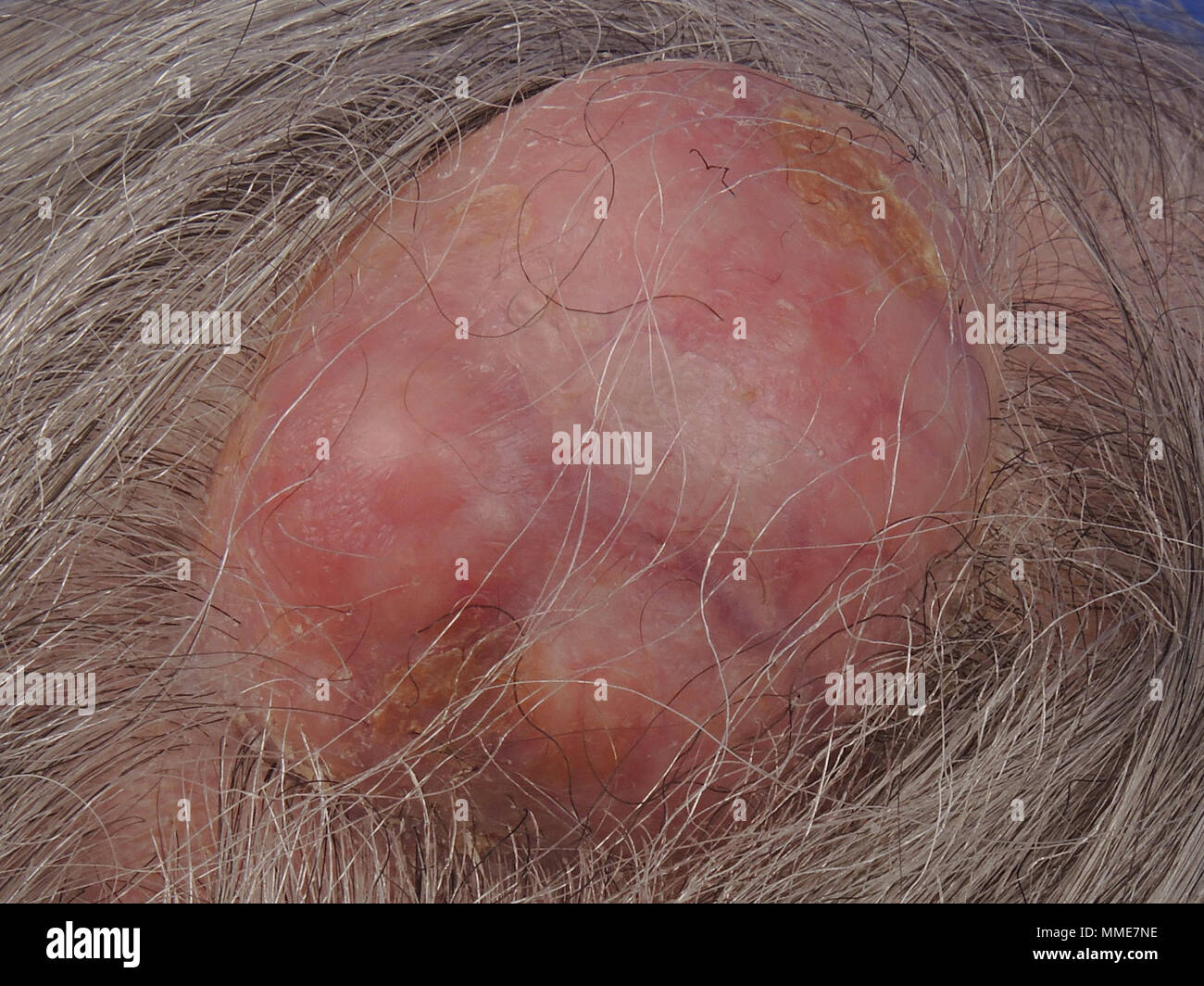 Quiste epidermoide fotografías e imágenes de alta resolución Alamy