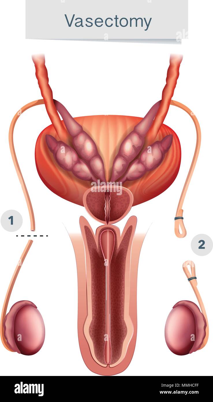 Anatomía Humana de la Vasectomía en la ilustración sobre fondo blanco. Ilustración del Vector