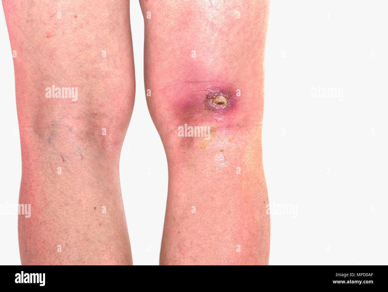 Absceso, inflamación del área popiteal popiteal zone en la pierna derecha,  herida infectada righe rodilla doblada Fotografía de stock - Alamy