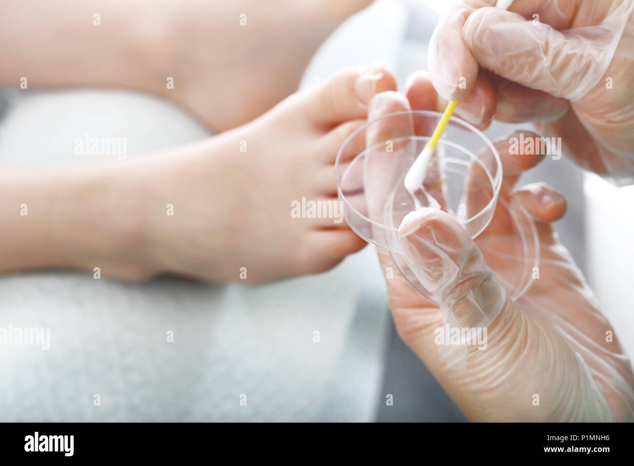 La micosis de los pies y las uñas. El dermatólogo toma un hisopo del paciente es el eje de la uña. Foto de stock