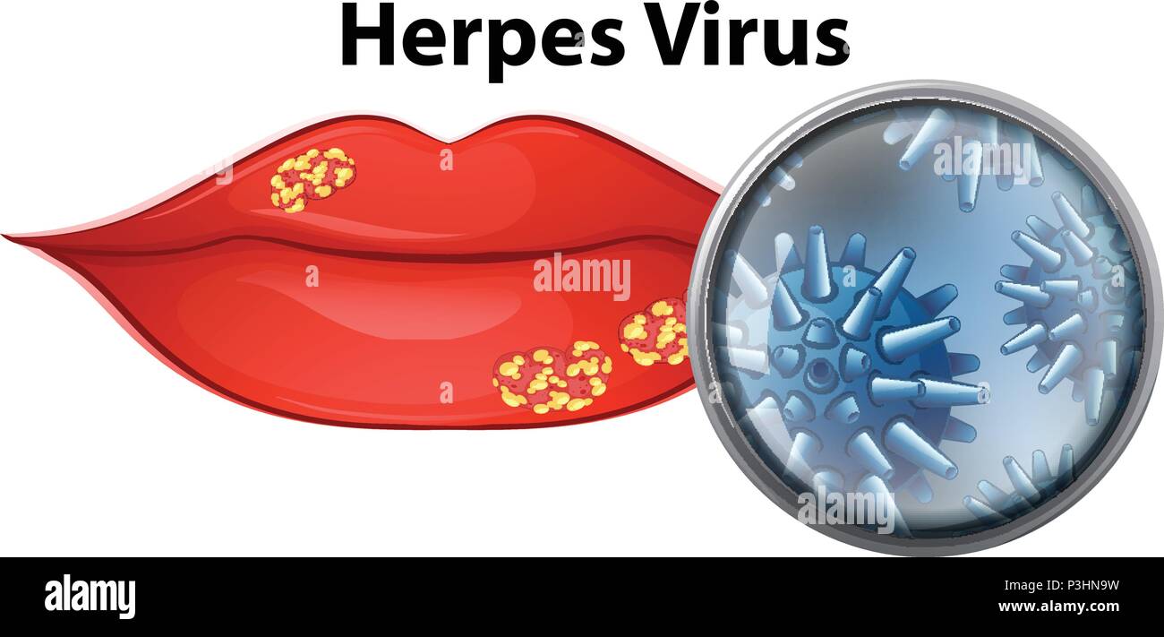 Una ilustración con el virus del herpes labial Imagen Vector de stock -  Alamy