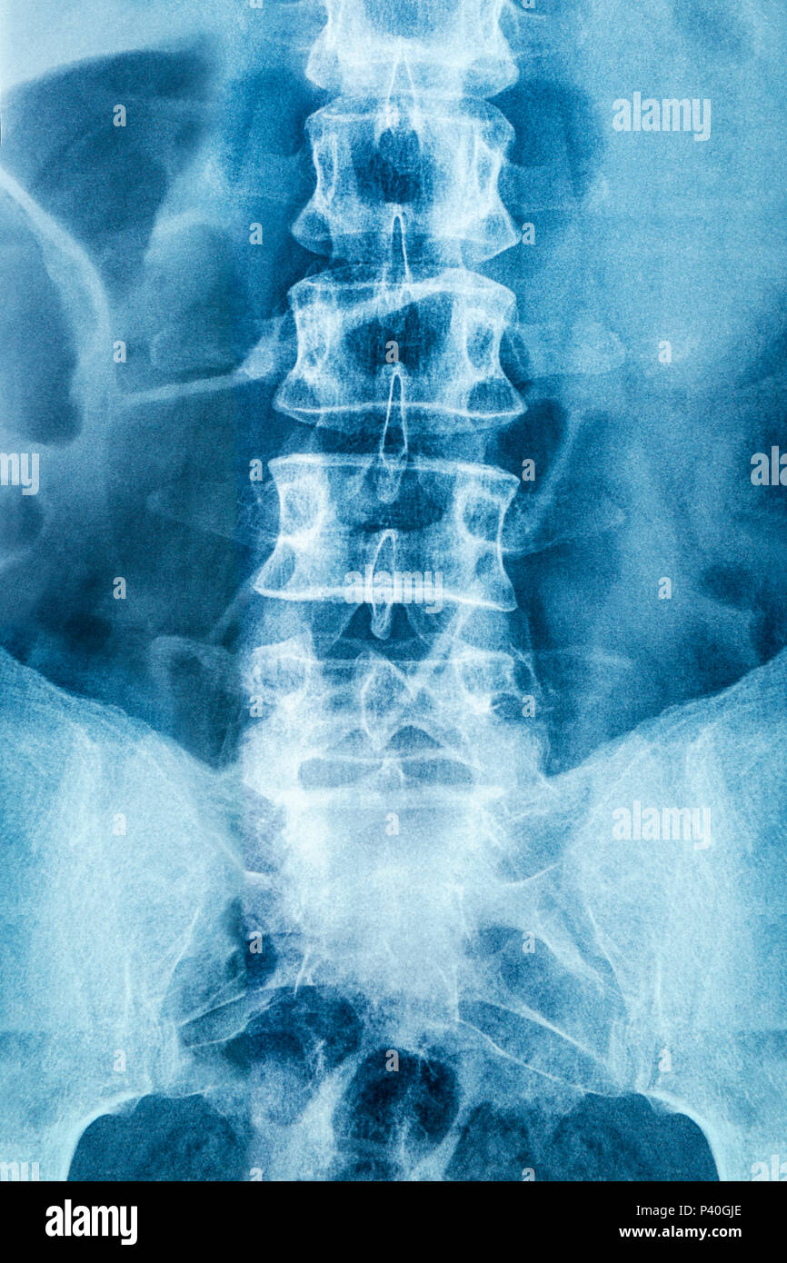 Vértebra Rayosx mostrando la espina lumbar Foto de stock
