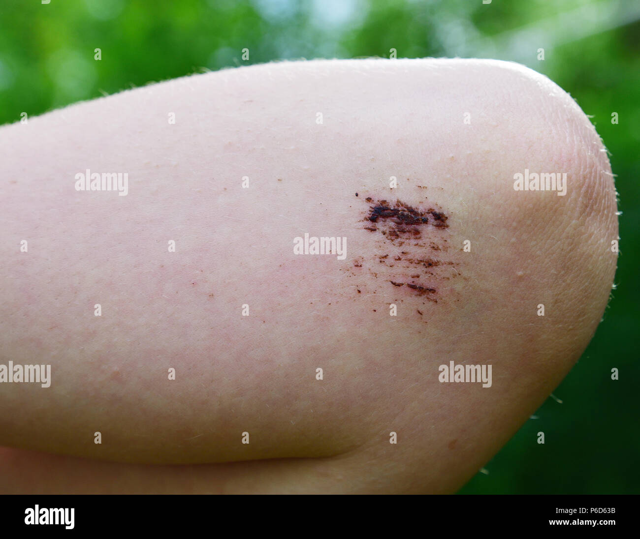 Las piernas de una adolescente con una fresca abrasión en el codo Foto de stock