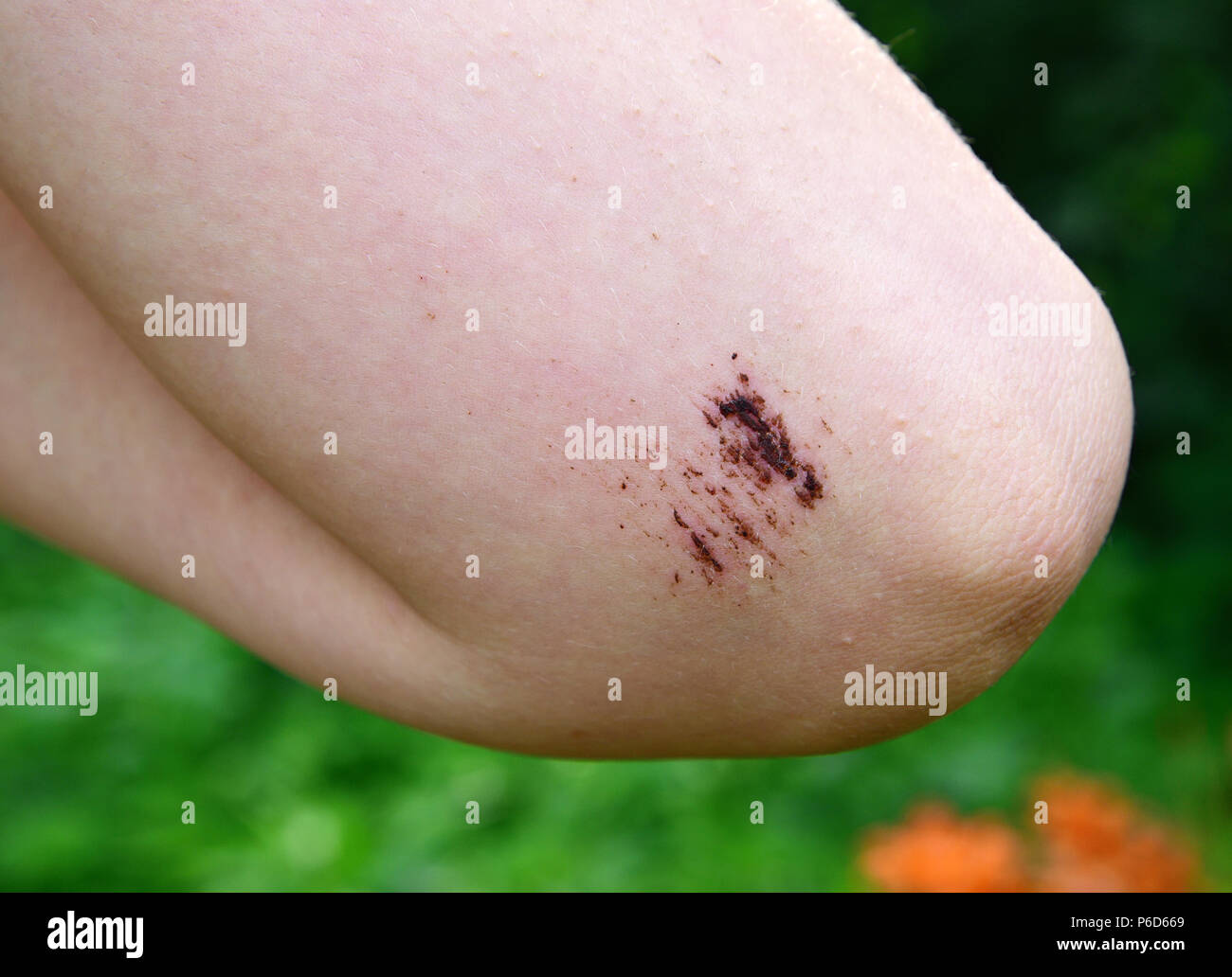 Las piernas de una adolescente con una fresca abrasión en el codo Foto de stock
