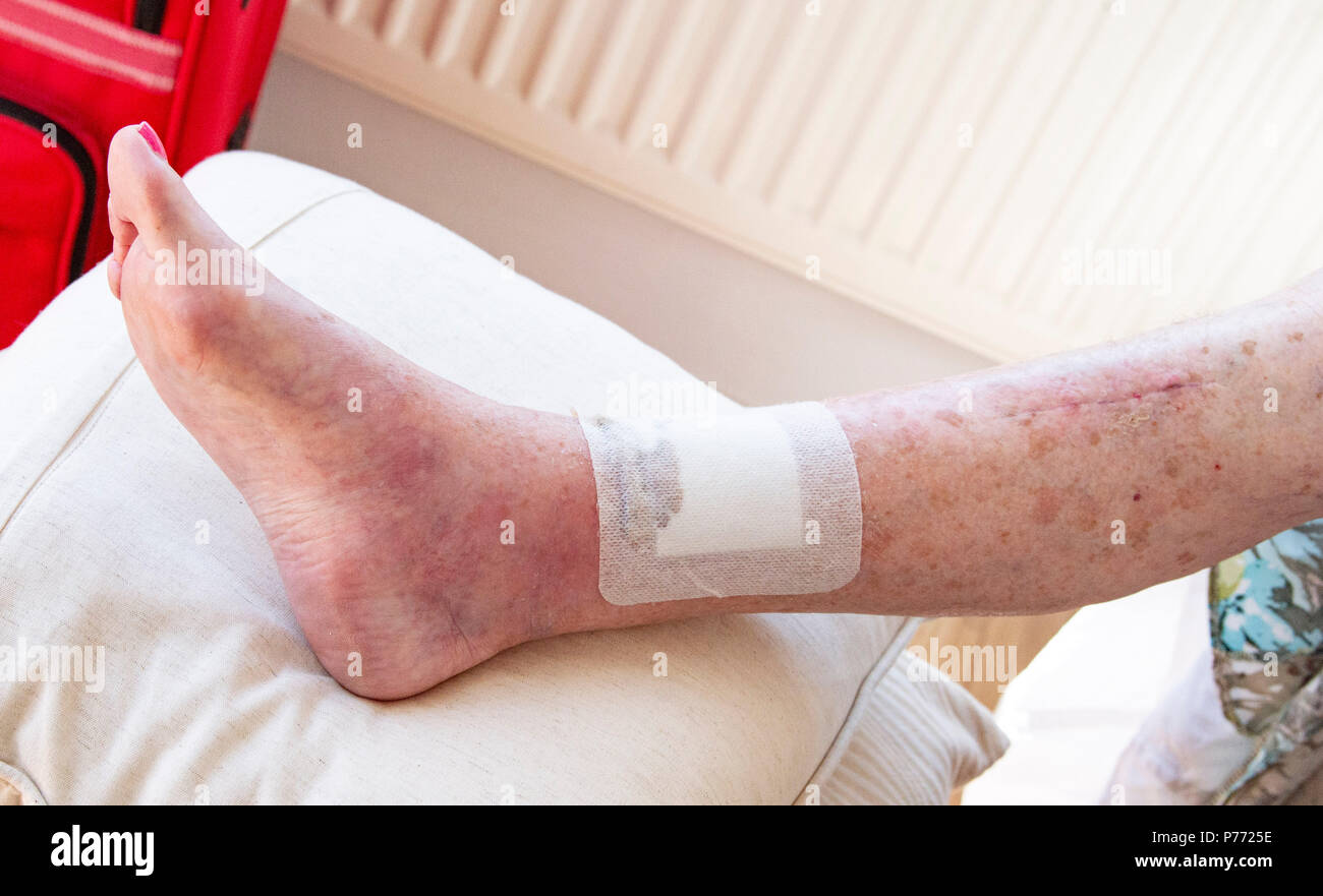 Anciana con cáncer de piel en las piernas después de la extracción la  operación cicatriz mostrando los tobillos hinchados plus Fotografía de  stock - Alamy