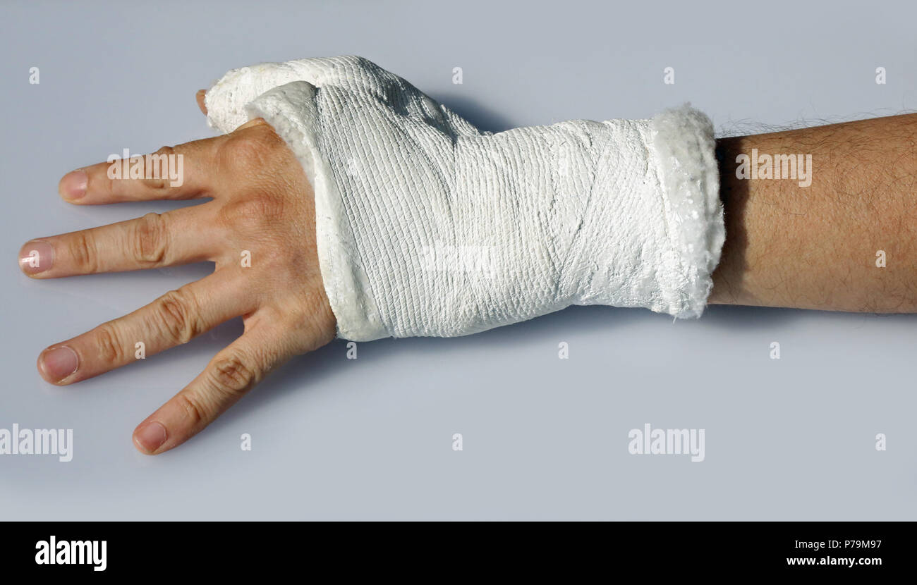 Fractura de la mano del hombre con yeso para inmovilizar la muñeca y el  pulgar Fotografía de stock - Alamy