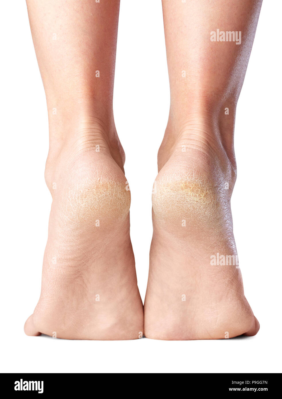 Dolor de la piel de los pies, talones seco Foto de stock