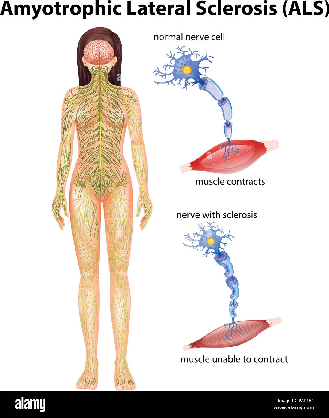 Hembra Ilustración De Esclerosis Lateral Amiotrófica Imagen Vector De Stock Alamy