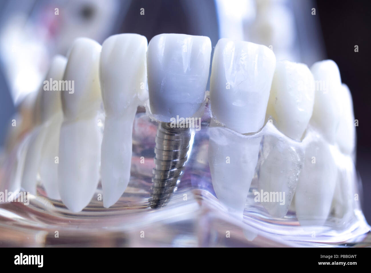 Modelo de enseñanza dientes dental dentista mostrando titanio metálico