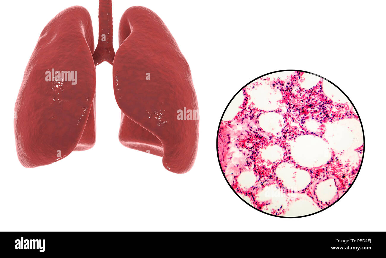 Ilustración que muestra el ordenador Anatomía del pulmón humano y una luz micrografía de una sección a través de tejido pulmonar sano mostrando los alvéolos (sacos de aire, blanco). Los alvéolos son el sitio de intercambio gaseoso, donde el oxígeno entra en la sangre y el dióxido de carbono es removido. Foto de stock