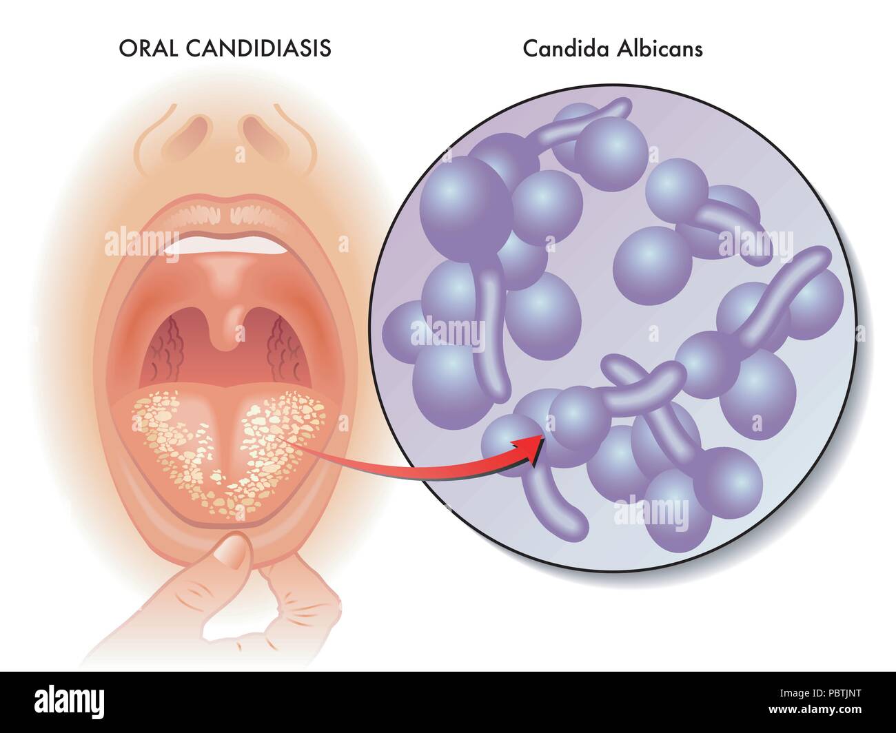 Un vector ilustración médica de lengua infección denominada candidiasis oral. Ilustración del Vector