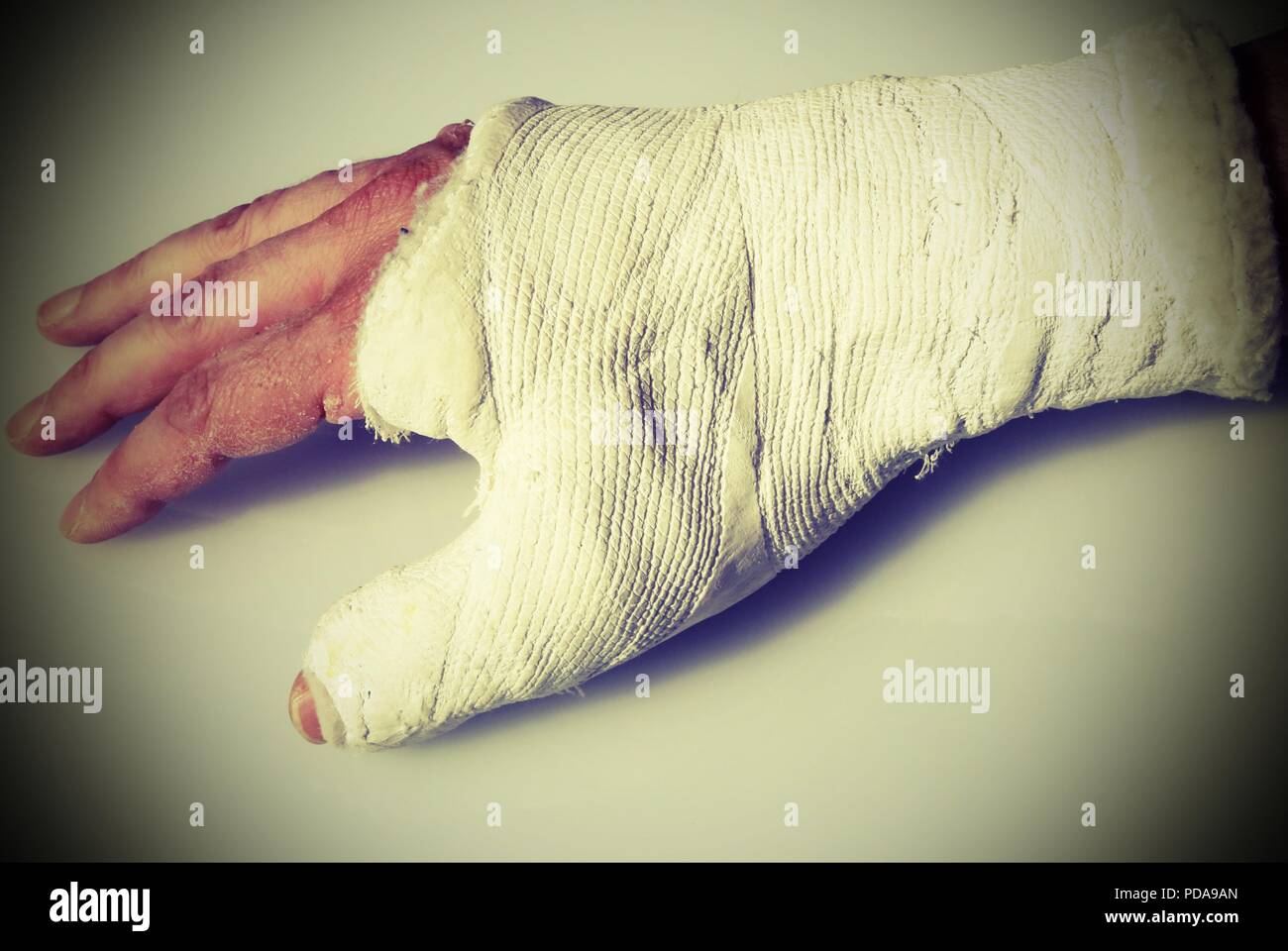 Fractura de mano del hombre con el yeso ortopédico en el hospital y un  efecto vintage generalizada Fotografía de stock - Alamy