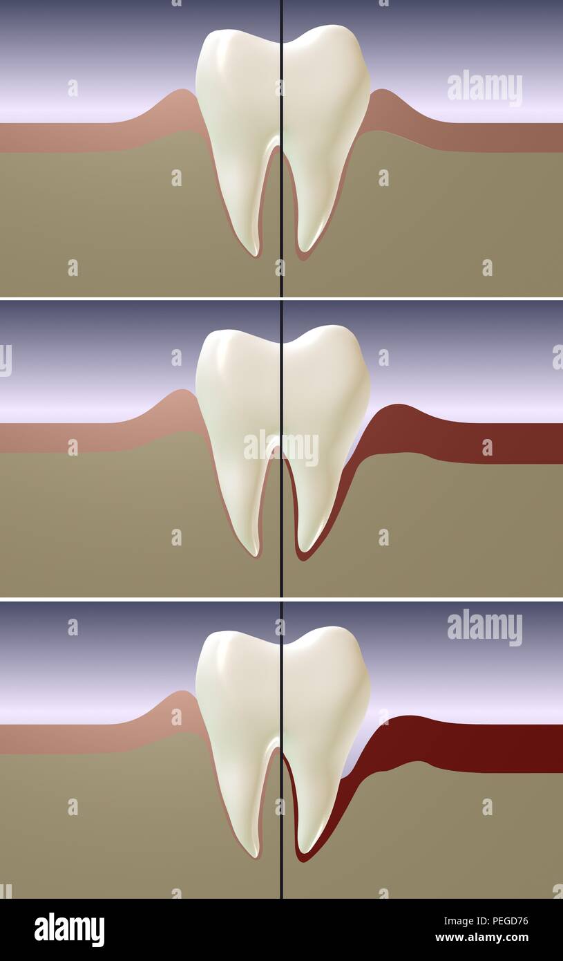 La enfermedad periodontal, la gingivitis y la encía 3D rendering