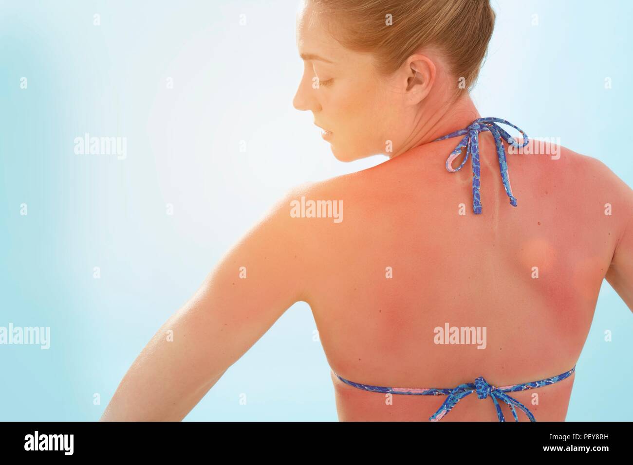 Mujer con la espalda quemada, vista trasera. Foto de stock